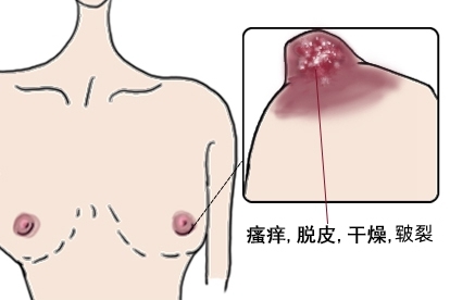 乳头真菌感染图片